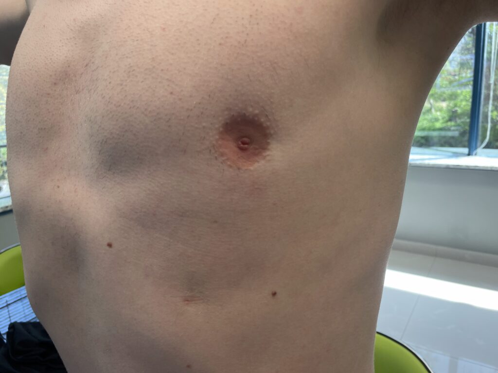 example of crater deformity after gynecomastia surgery